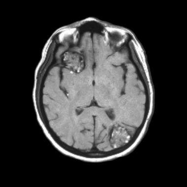 脑海绵状血管瘤磁共振诊断 如何看MRI影像资料