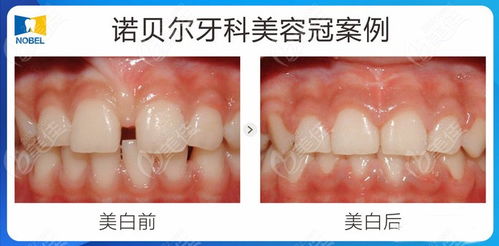 西安诺贝尔牙科可以刷医保卡吗 听说做种植牙即使不用医保也很便宜