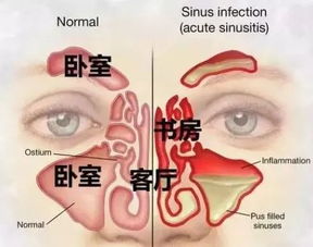 什么茶治鼻窦炎