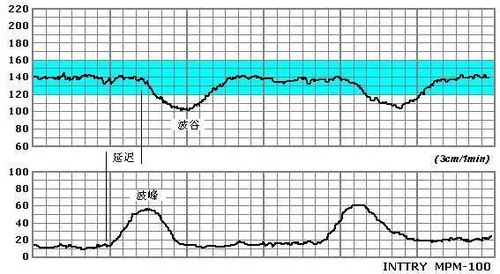 孕妈们需要了解的胎心监护小知识
