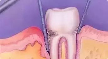 牙齿矫正会导致牙齿松动 其实是你牙龈萎缩了 