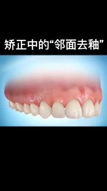 矫正牙齿中的邻面去釉 