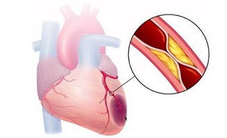 心脏功能变弱有多要命 试试这三个强壮心脏的保命剂 