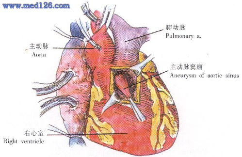 主动脉窦瘤 修复手术操作步骤,图片图谱图解,手术治疗方法,诊断血管手术 