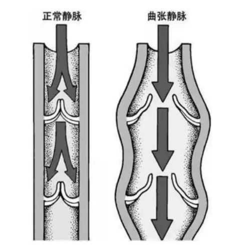 精索静脉曲张 男性不育的常见原因
