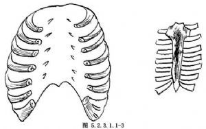 胸骨部分或全部切除与重建