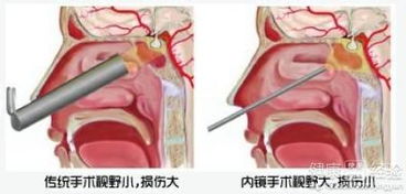 泌乳素垂体瘤影响血糖吗