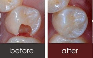 树脂补牙后注意事项(用树脂补牙后一般能维持几年)