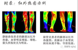 乳房红外热成像检查