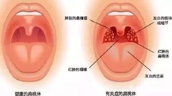 肾病患者, 扁桃体切还是不切