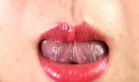 看一下舌头下的青筋,真能知道血管堵没堵吗 舌筋变粗代表什么