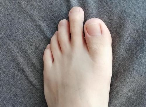 脚趾的形状有几种