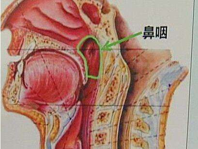 鼻咽癌前兆都有哪些 如何预防鼻咽癌