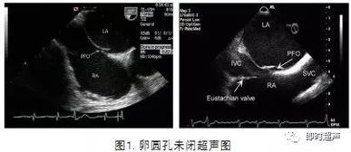 孕期胎儿心脏超声常见问题集锦 