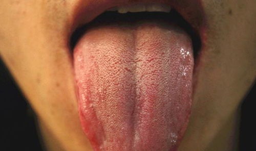 舌头发紫是什么原因造成的(舌头发紫是什么原因造成的舌头发黑图片)