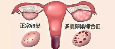 月经不规律，受孕困难，警惕多囊卵巢综合征！