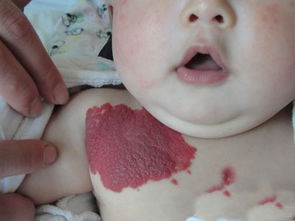 宝宝出生后有红色胎记 家长别大意很可能是血管瘤 