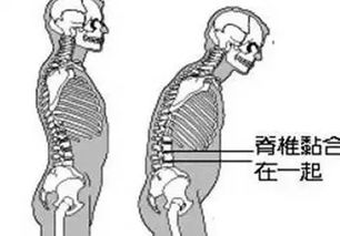 你好。我今年37岁。强直性脊柱炎累及双髋。平时什么体力活都不做。请问要换第四代纳米陶瓷股骨头能用多