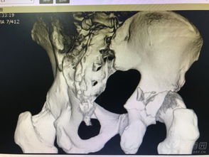 髋臼后壁粉碎性骨折