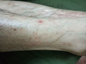 皮肤痒尤其晚上小腿大腿痒的厉害,经常抓破皮 