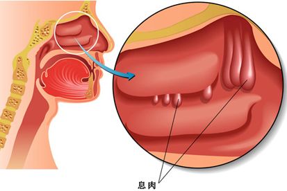 鼻息肉会癌变吗 如何有效治疗