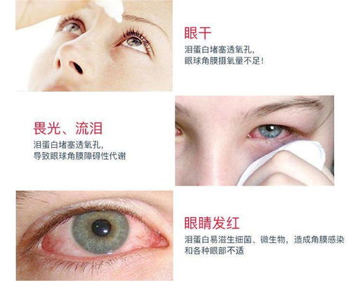 导致你眼睛感染 不舒服未必是隐形眼镜的锅,可能是泪蛋白的错 
