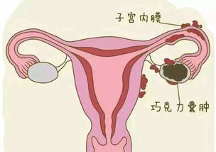子宫内膜增厚影响怀孕吗？可以成功试管好孕吗？