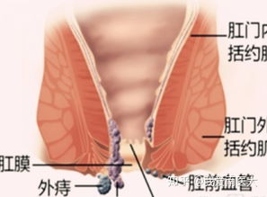 血栓性外痔怎么治疗,康复了的人来帮忙啊 