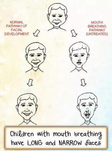 用嘴呼吸真的很影响面部轮廓吗(用嘴呼吸会不会影响脸变形)