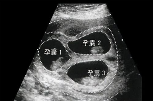 郑州女子怀上八胞胎,她是怎么怀上的 是否能安全生下八胞胎