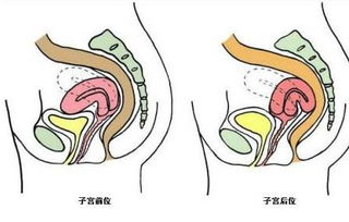 准备怀孕的女性注意 6大子宫问题影响怀孕