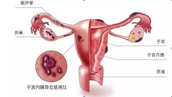 不孕 武大夫 我月经12天 内膜c12，欠均质，是不是必须宫腔镜啊