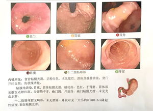 刚做完胃镜 医生诊断慢性浅表性胃炎,十二指肠隆起性病变 什么意思啊 病变会是息肉 肿瘤 