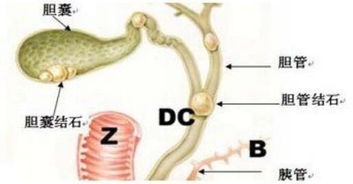 胆管结石病的预防