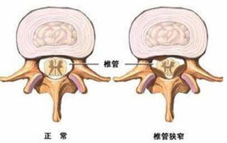 科普 椎管狭窄术后如何正确恢复 