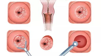 HPV 疫苗要不要打 这些女性健康问题,你都要清楚