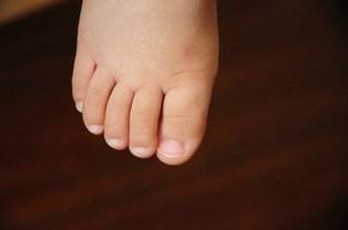 小脚趾指甲分瓣是啥情况 祖先是希腊人 