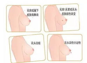 这些症状可能是乳腺癌预警信号 