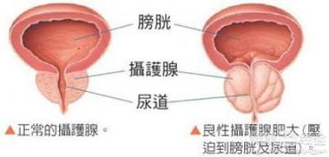 为什么跟骨增生不建议手术