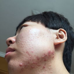 这几个月下巴上长了好多痘痘,一开始是闭合性粉刺,现在成这样了,请问这是什么原因造成的,怎么治疗 