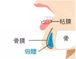 假体垫下巴术后效果怎么样