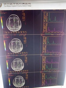 遇到一个病人,不能确诊,大家给点意见,至于脑活检就别提了,家人不同意