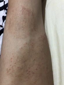 女性大腿根部内裤边缘有痣