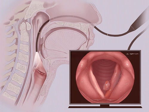 喉咙发不出声,是 声带息肉 在作祟