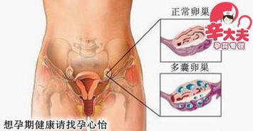 女性朋友应该如何保护卵巢 提高受孕几率 