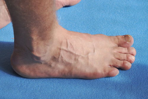 刘晓宇左脚热身赛受伤，初步诊断左脚崴脚并肿胀