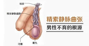 精索静脉曲张的冷知识？精索静脉曲张讲解