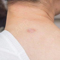 到江城做第四次疤痕治疗,现在脖子上和后背的疤痕已经...激光祛疤 悦美整形 