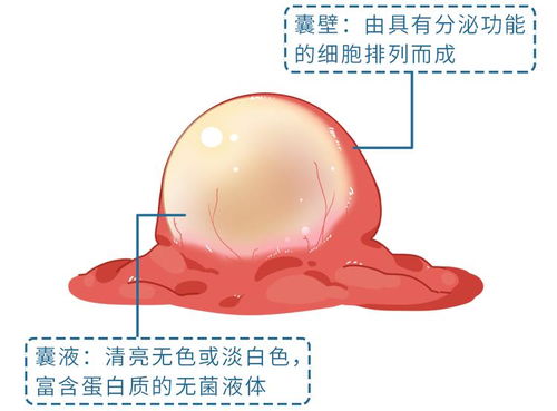 腰痛无力 当心肾脏长了这种异物,直径可达10cm