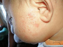 婴儿面部湿疹(婴儿湿疹有什么办法根治)